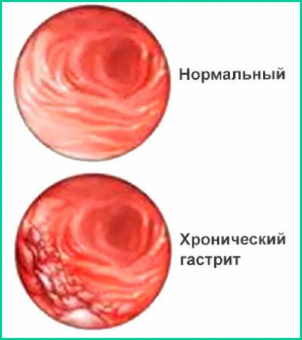 Вариолиформный гастрит. Лимфоцитарный гастрит эндоскопия. Гастрит, хронический гастрит.
