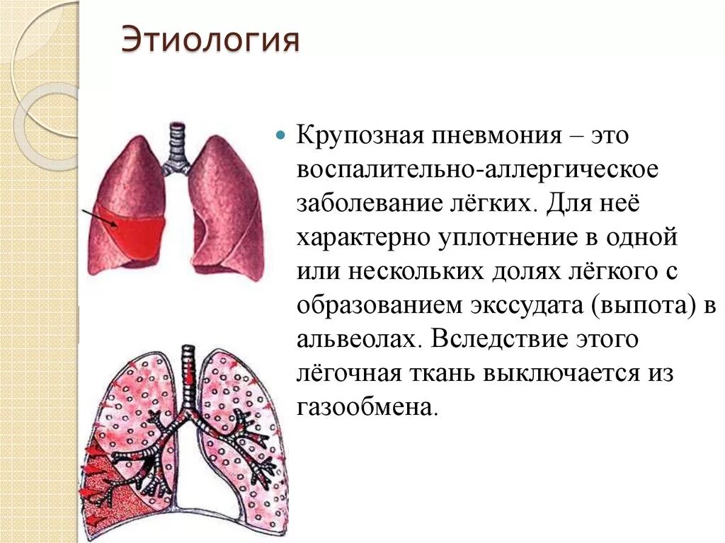 Заболевания левого легкого. 3 Стадия крупозной пневмонии. Объем поражения легких при крупозной пневмонии. Острая крупозная пневмония симптомы. Крупозное воспаление легких.