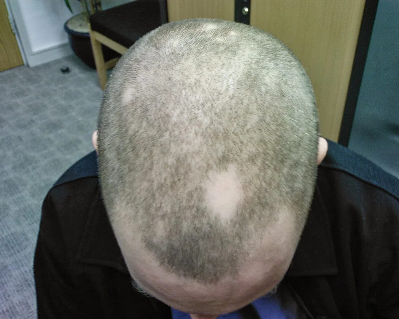 Гнездная алопеция офиазис. Очаговая алопеция (alopecia areata). На голове появляется лысина. Гнёздная алопеция у мужчин. Залысина на затылке у ребенка 5 лет.