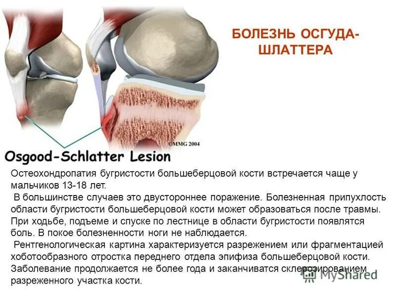 Лечение костных заболеваний. Болезнь Осгуд Шляттера у детей. Бугристости большеберцовой кости (болезнь Осгуда-Шлаттера). Болезнь Осгуд Шляттера степени рентген. 1 Степень болезни Осгуда Шлаттера.