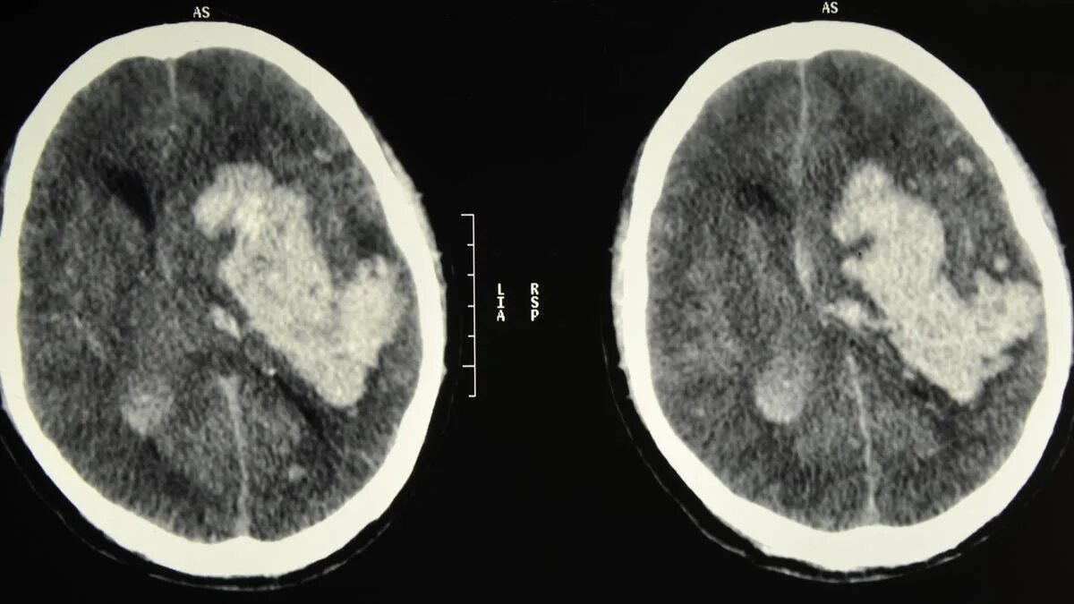 Смерть от отека мозга. Энцефалит головного мозга кт. Вазогенный отек головного мозга кт. Энцефалит головного мозга по кт головного мозга. Отёк головного мозга g93.