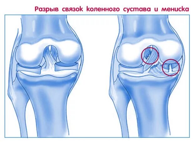 Крестообразные связки бедра