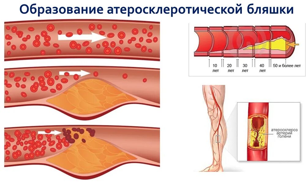 Возникновение тромбов. Тромбоз атеросклеротической бляшки. Атеросклероз стадии образования бляшек. Что такое холестериновых бляшек и закупорки сосудов. Атеросклерозная бляшка сосуда.