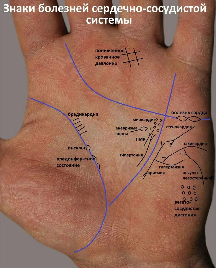 Болезни на руке хиромантия. Знаки на ладони хиромантия. Болезни по линиям на ладони. Болезни по линии жизни.
