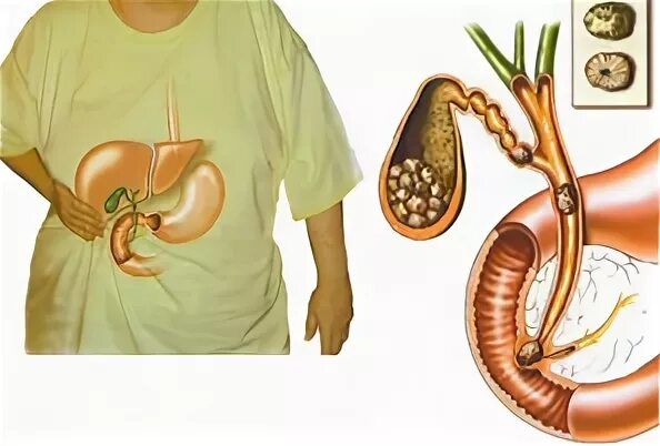 Желчный пузырь мясников. ЖКБ камни желчного пузыря. Осложнения ЖКБ. Желчный пузырь желчнокаменная болезнь. Желчный пузырь при желчнокаменной болезни.