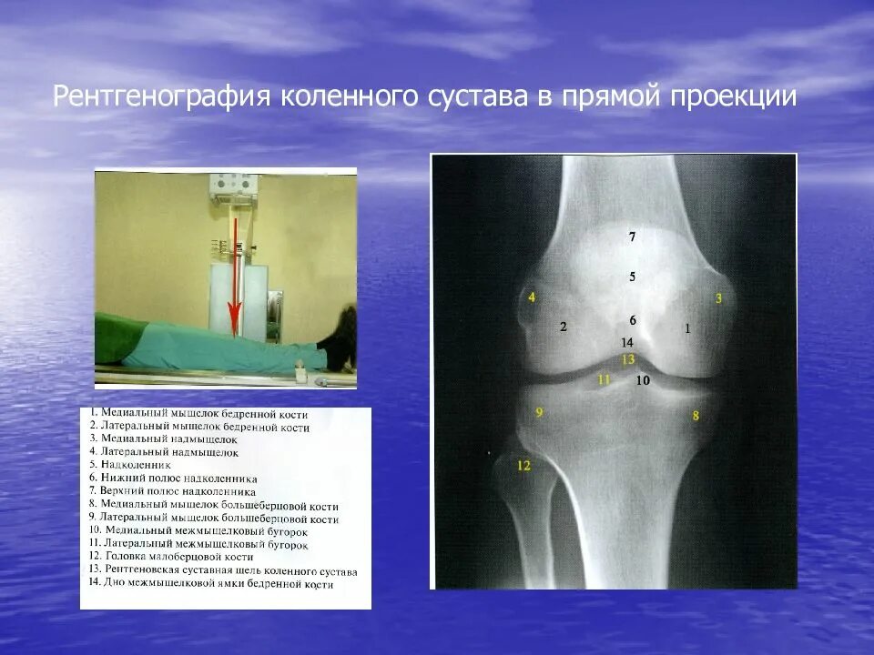 Рентген коленного сустава проекции