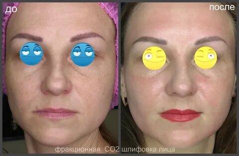 Лазерная шлифовка кожи skinlift