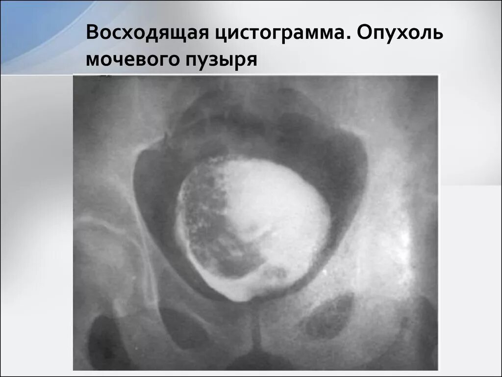 Рак мочевого пузыря что делать. Опухоль мочевого пузыря цистограмма. опухоль мочевого пузыря цистография рентген. доброкачественная опухоль мочевого пузыря рентген. внутрипросветное объемное образование мочевого пузыря.
