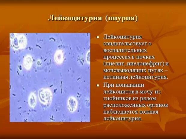 Появление лейкоцитов в моче. Причины повышения лейкоцитов в моче. Как называется большое количество лейкоцитов в моче. Лейкоциты (микроскопия) 2.