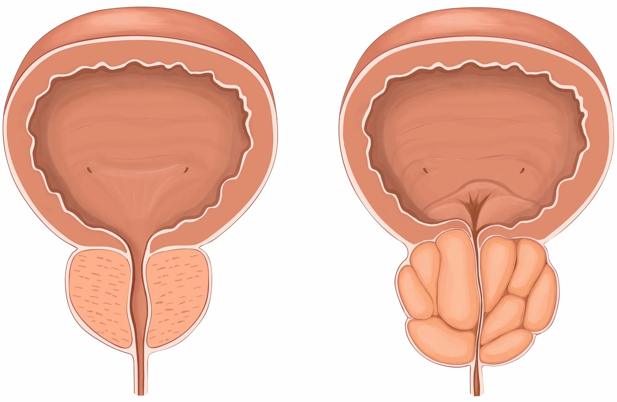 Простата действий. Аденома предстательной железы. Простатит предстательной железы. Аденома предстательной железы (аденома простаты).