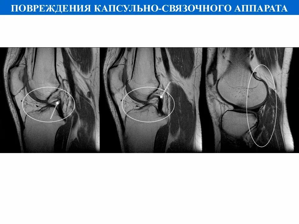 Повреждение связочного аппарата. Повреждение капсульного связанного аппарата. Повреждение капсульно-связочного аппарата. Повреждение капсульно связочного аппарата колена.