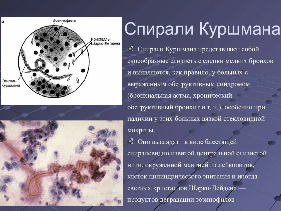 Мокроты еразнере. Спирали Куршмана и Кристаллы Шарко-Лейдена. Микроскопия мокроты спирали Куршмана. Спирали Куршмана, Кристаллы Шарко-Лейдена, эозинофилы. Спирали Куршмана и Кристаллы Шарко-Лейдена в мокроте.