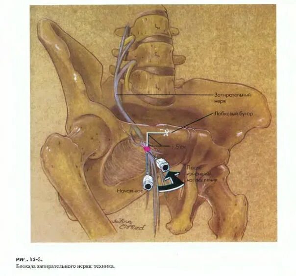 Половой нерв у мужчин симптомы. Трансвагинальная блокада полового нерва. Запирательный нерв. Блокада полового нерва техника.