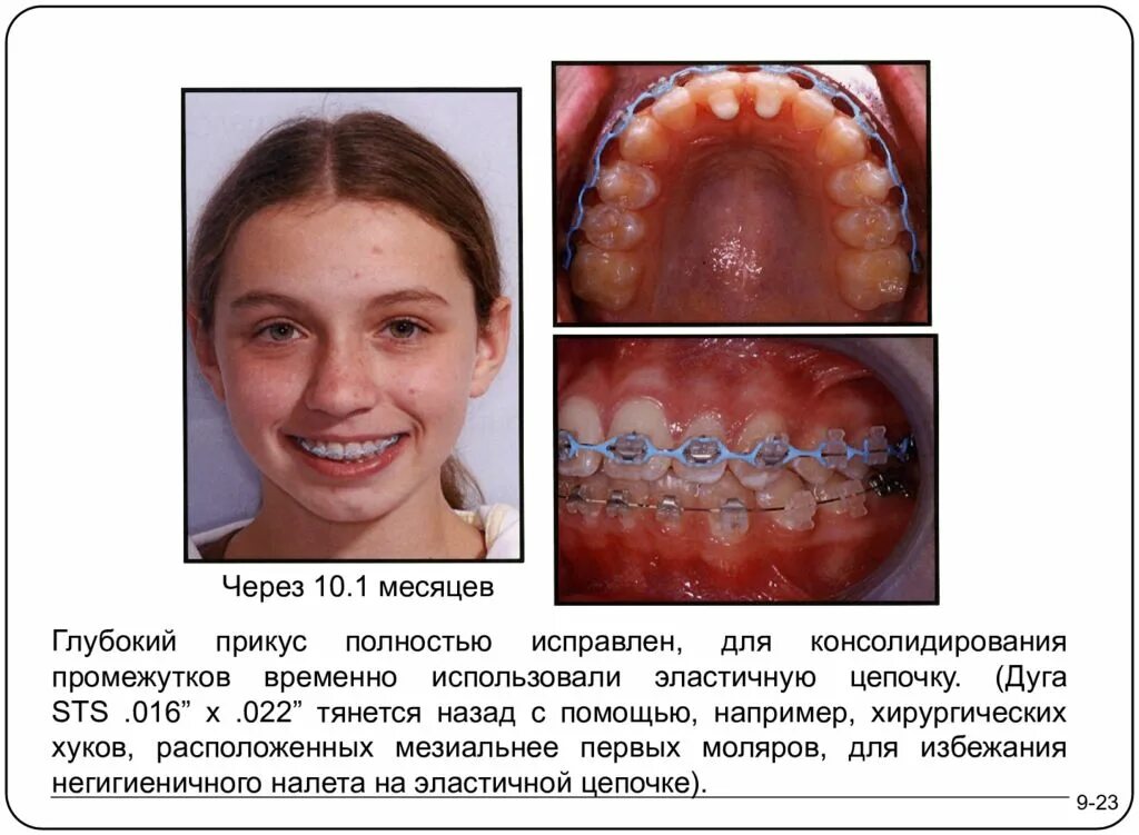 Appetite сковорода 20см brown stone. Пр глубокий. Дистальный прикус (птичий профиль). Сковорода appetite brown stone 24см. Appetite grey stone gr6241.
