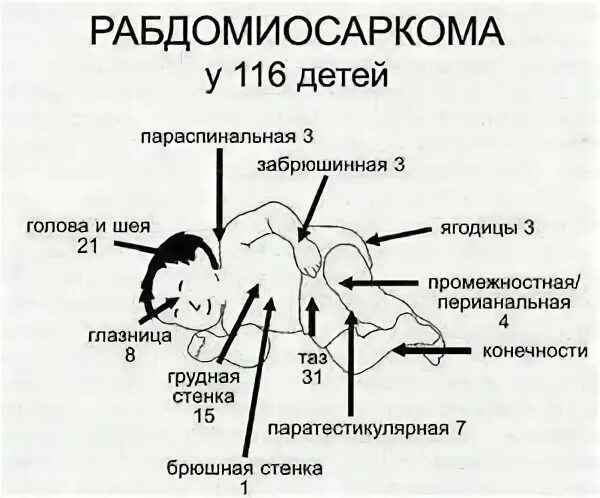 Альвеолярный рабдлмиосаркома. Альвеолярная рабдомиосаркома у детей. Альвеолярная рабдомиосаркома. Характеристика рабдомиосаркомы. Эмбриональная рабдомиосаркома гистология.