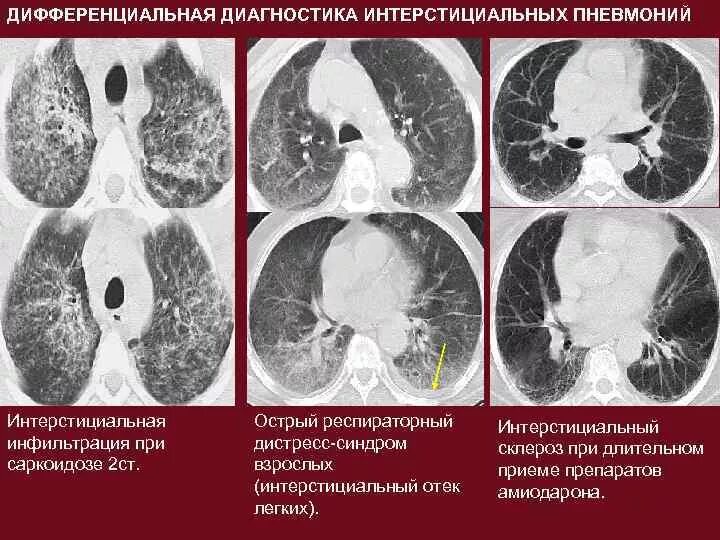 Интерстициальный пневмонит кт картина. Интерстициальный отек легкого на кт. Интерстициальная пневмония на кт. Интерстициальная инфильтрация кт. Гипостатические изменения в легких