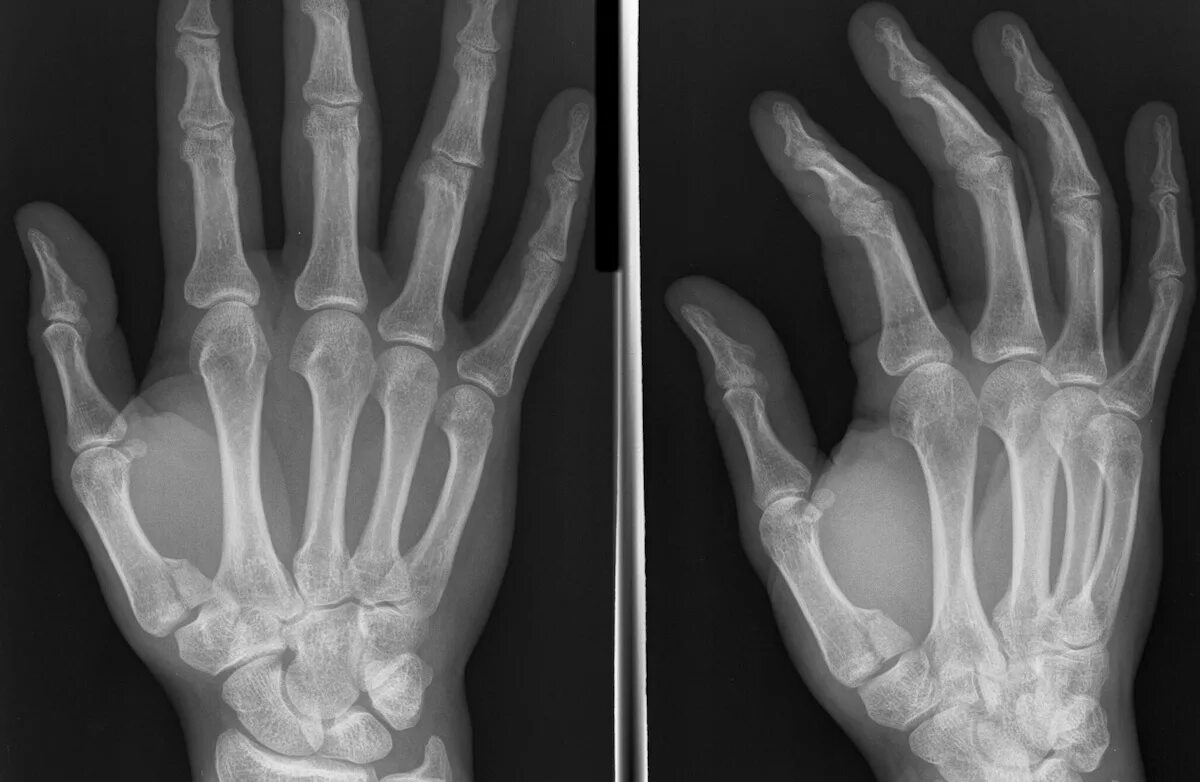 Перелом Беннета 1 пястной кости. Перелом 1 пястной кости большого пальца. Перелом Беннета рентген. Перелом пястной кости большого пальца рентген.
