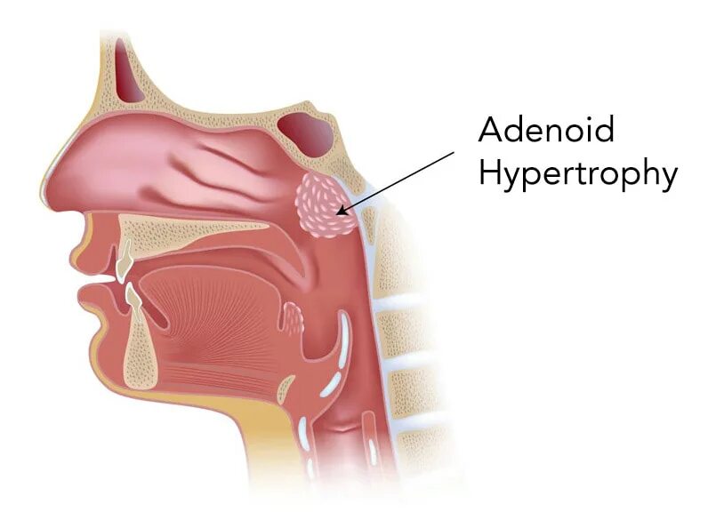 Носовая полость аденоиды. Анатомия носоглотки аденоиды. Носовая полость аденоиды у ребёнка.