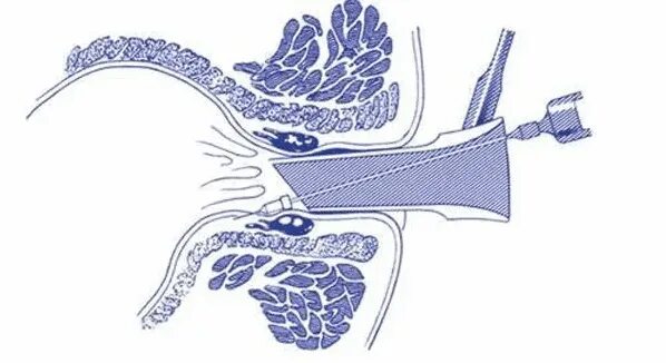 Врач при геморрое у мужчин. Склерозирование внутренних геморроидальных узлов. Склеротерапия внутренних геморроидальных узлов. Наружные узлы склерозирование. Склерозирование геморроя.