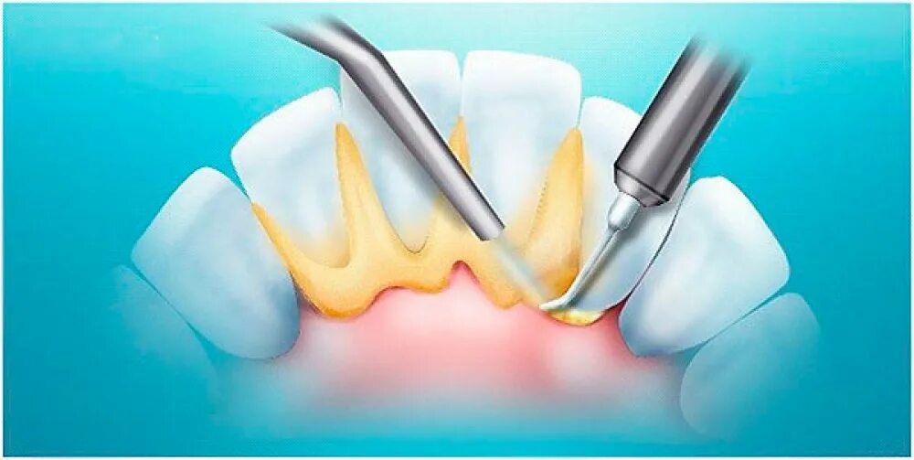 Поддесневые отложения зубной камень. Неминерализованные зубные отложения. Поддесневой зубной камень. Зубной какамекакамень. Лазерное десен