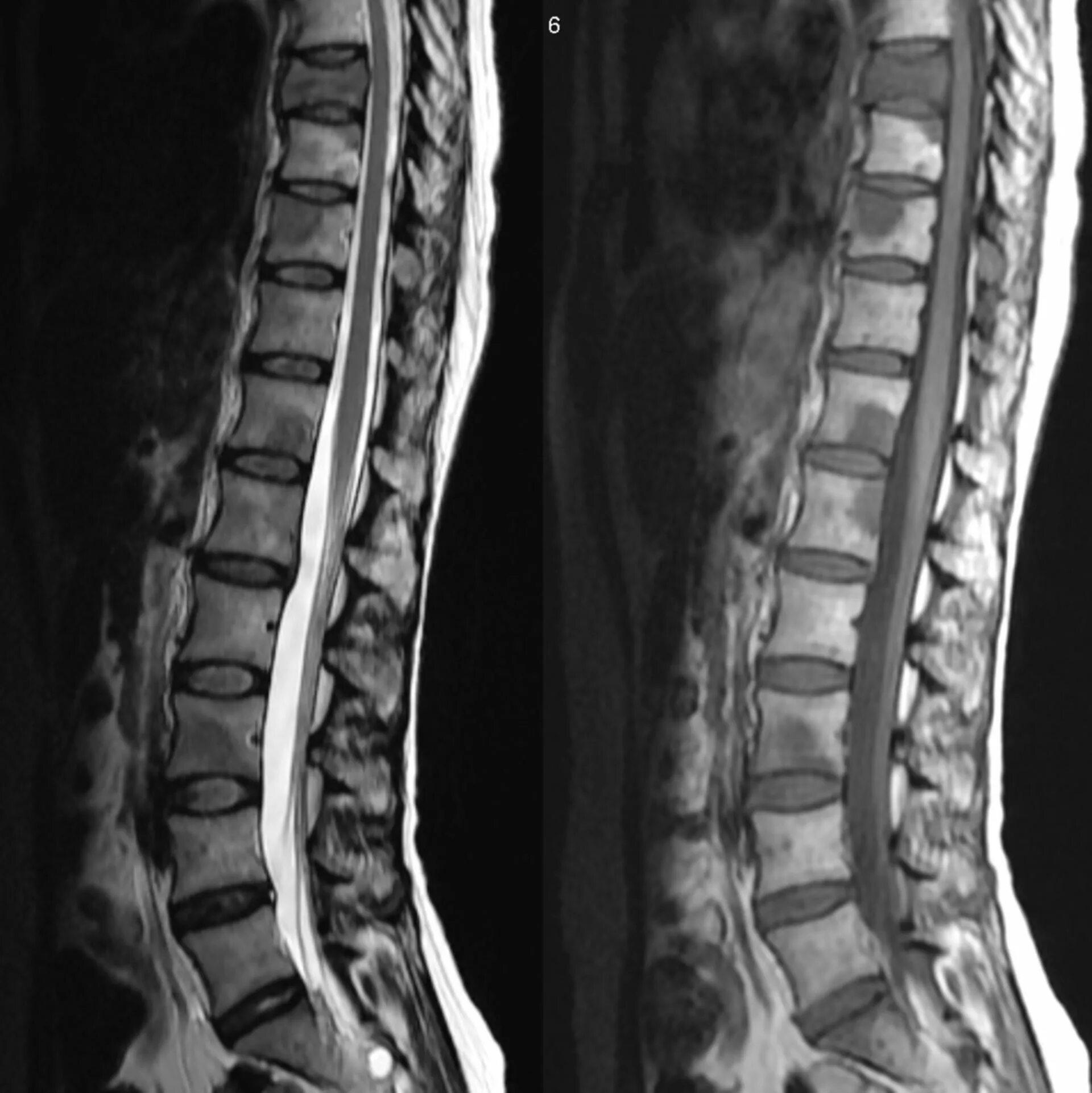 Трабекулярный отёк l5-s1. Отёк костного мозга позвоночника l3-l4. Трабекулярный отек костного мозга позвоночника. Мрт лимфома грудной отдел позвоночника. Опухоль в поясничном отделе