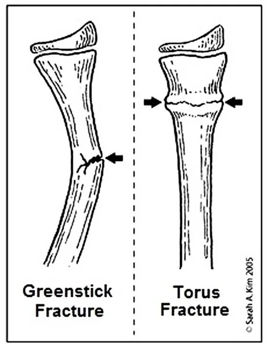 The fracture can be. The fracture can be
