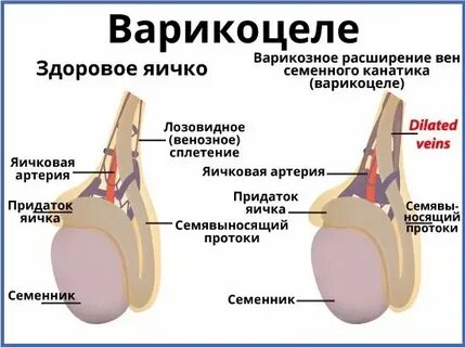 Побаливают яички причины