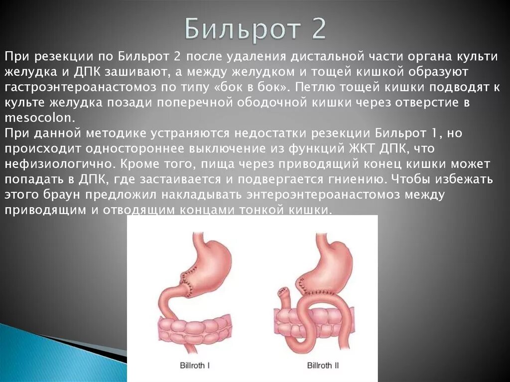 Резекция желудка анемия. Резекция желудка Бильрот 1 и Бильрот 2. Отличия резекции желудка Бильрот 1 и 2. Модификации резекции желудка по Бильрот 2.