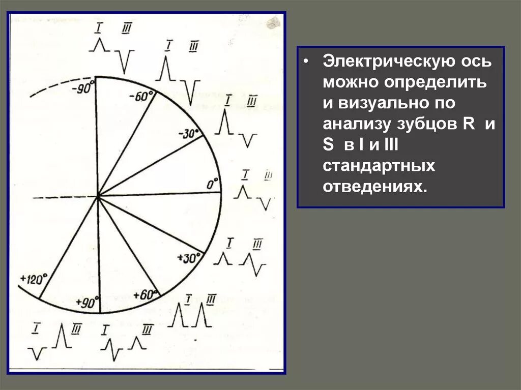 Как определить ось сердца. Электрическая ось по r. вертикальная электрическая ось сердца r. электрическая ось сердца визуально. электрическая ось по зубцам r.