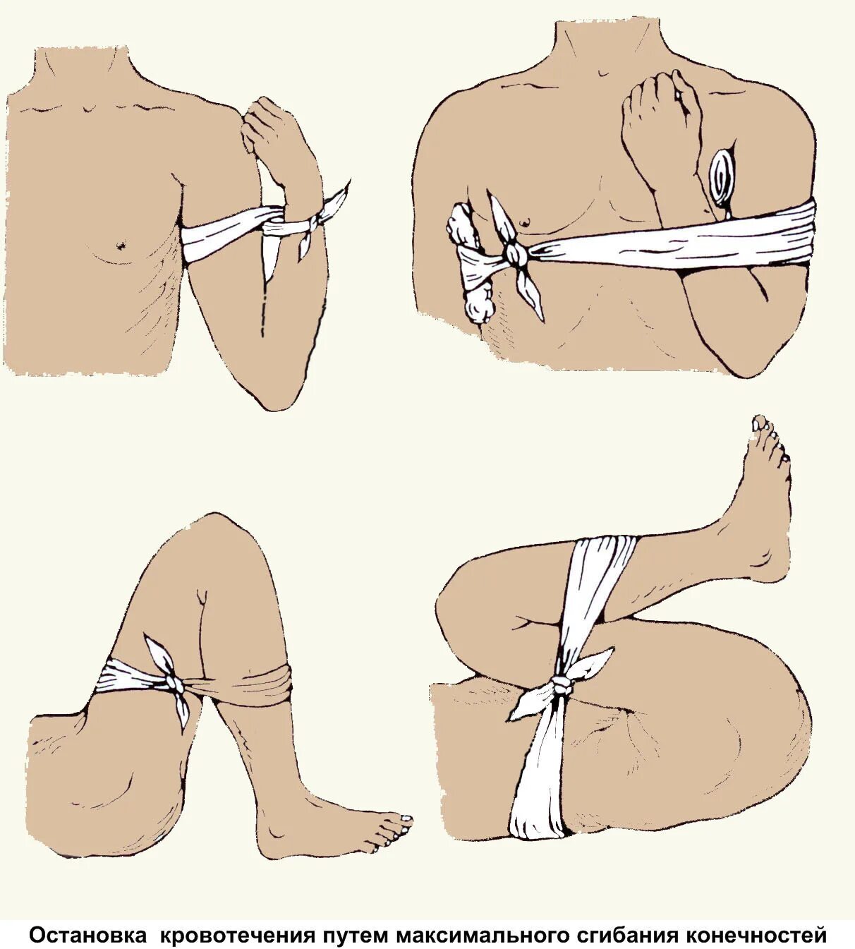 Остановка кровотечения методом максимального сгибания конечности. Фиксирование жгута при кровотечении. Остановкакровотеечния. Остановка кровотечени. Как остановить кровотечение конечностей