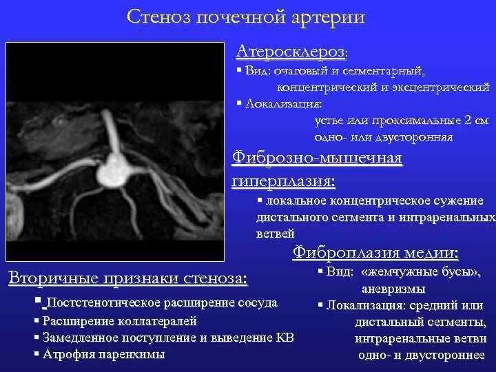 Сужение почечной артерии симптомы. Стеноз почечной артерии на УЗИ. Стеноз почечной артерии симптомы. Фибромускулярный стеноз.