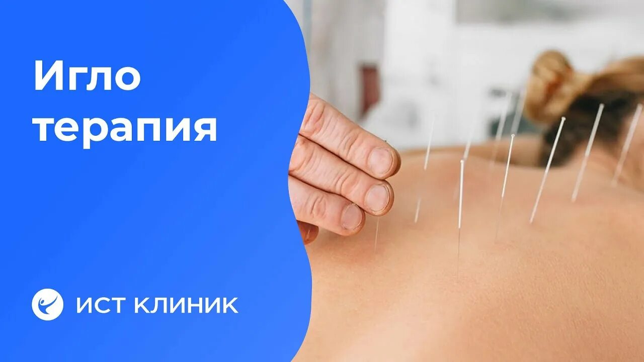 Иглоукалывание в больнице. Иглоукалывание. иглорефлексотерапия. иглорефлексотерапия цистит. иглорефлексотерапия при цистите у женщин.