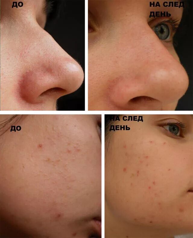 Лицо после механической чистки. Чем успокоить лицо после чистки. Результат после чистки лица. Маска после чистки. Результат после чистки лица.