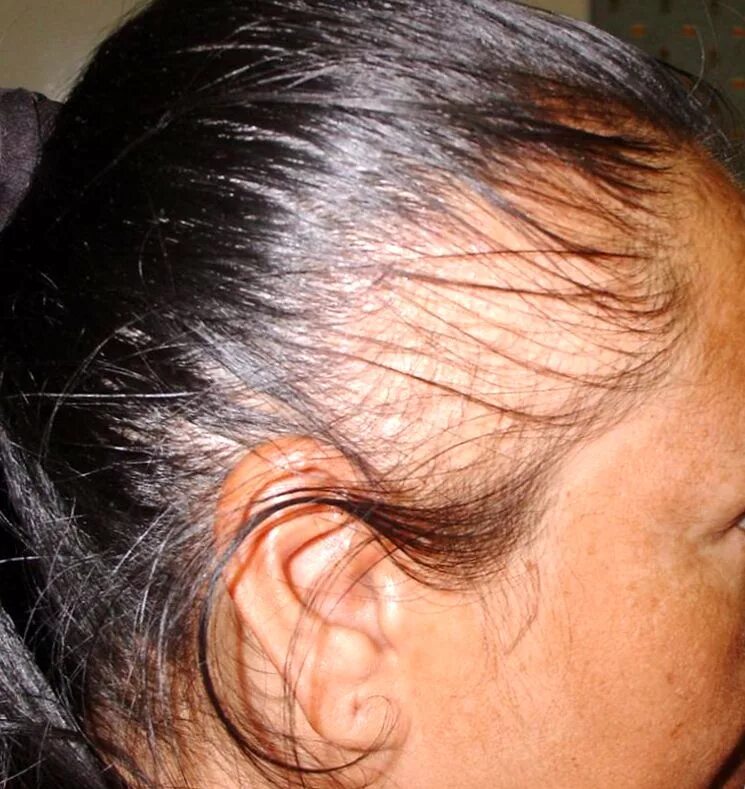 Выпадают волосы у женщины сильно на голове. Рубцовая алопеция псевдопелада Брока.