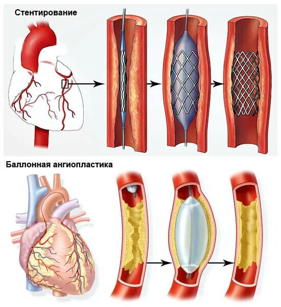 Баллонная коронарная ангиопластика. Коронарное стентирование сосудов сердца. Атеросклероз сосудов сердца стентирование. Коронарная ангиопластика и стентирование. Стент баллонная ангиопластика.