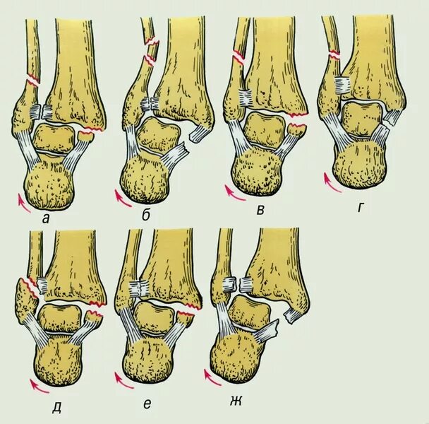 Перелом лодыжки синдесмоз. Пронационный перелом лод. Перелом лодыжки внешней кости. Подтаранный подвывих стопы кнаружи.