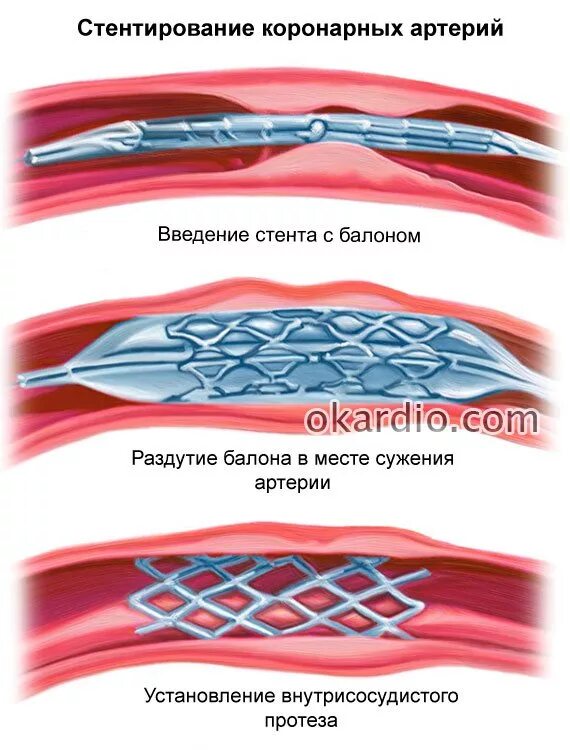 После стентирования какие