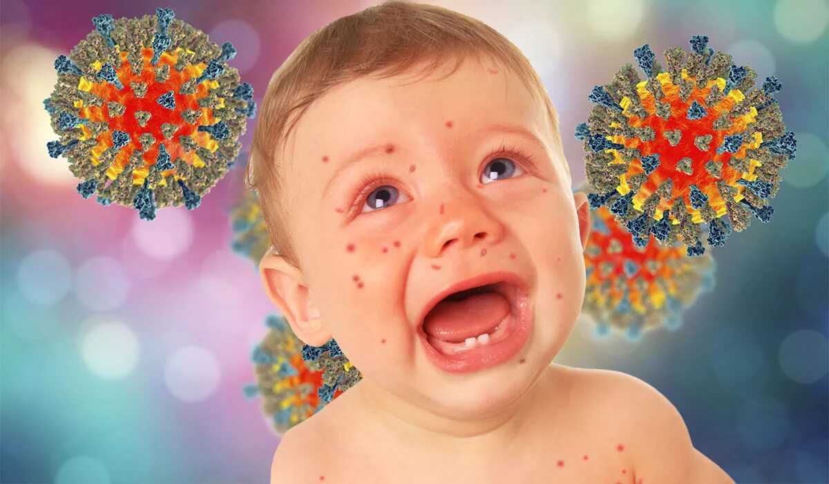 Вирус кори заболевание. Вирус кори человека. Вирус кори человека. Вирус кори вызывает в культуре клеток. Парамиксовирус паротит.