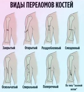 Выберите виды переломов
