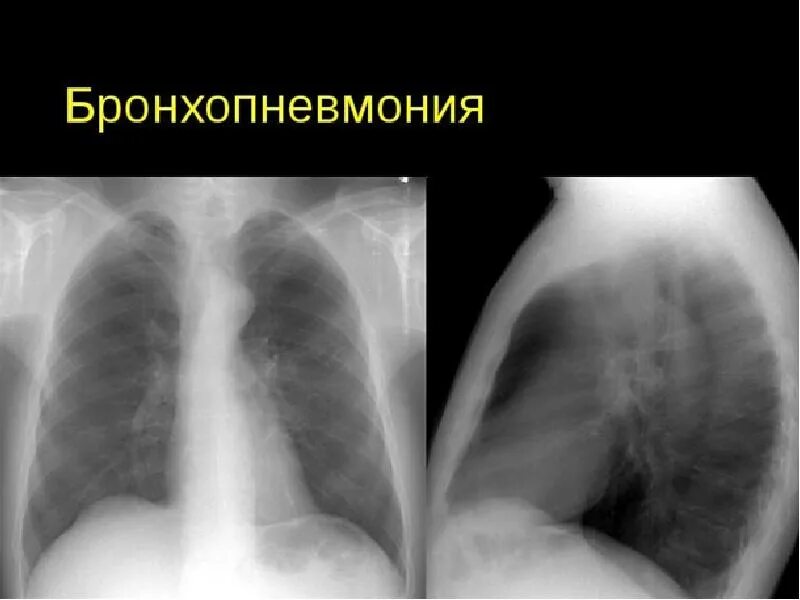 Очаговый бронхит. Очаговая пневмония бронхопневмония. Правосторонняя бронхопневмония (очаговая). Правосторонняя бронхопневмония рентген. Крупозная пневмония и бронхопневмония.