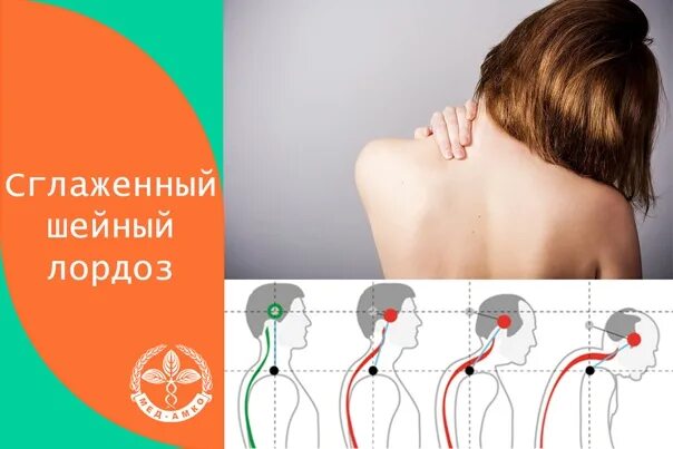 Нарушение статики выпрямление лордоза. Нарушение статики выпрямление лордоза