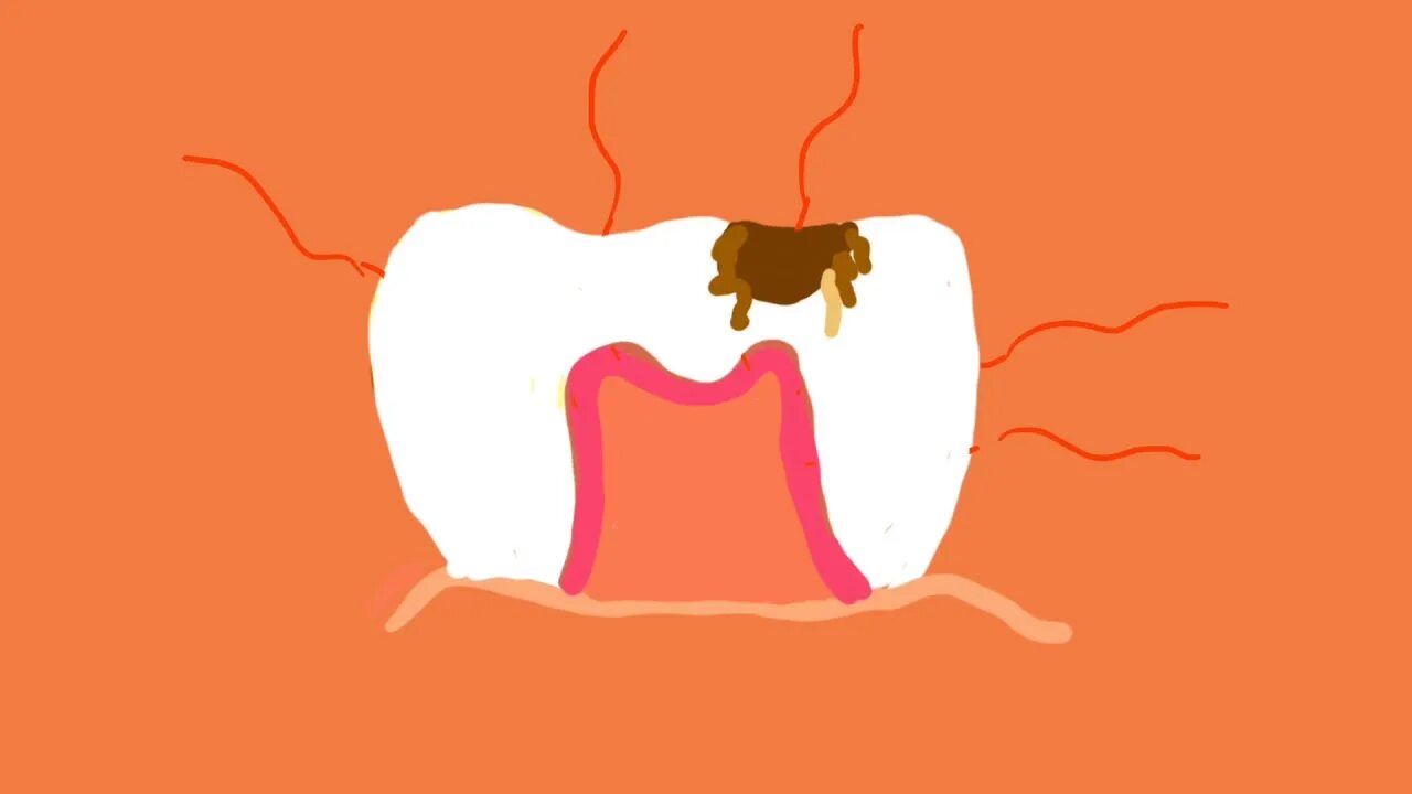 Невролиз тройничный нерв. Трансфораминальная блокада. Болит убитый нерв. Убивание зубного нерва. Трансфораминальная блокада.