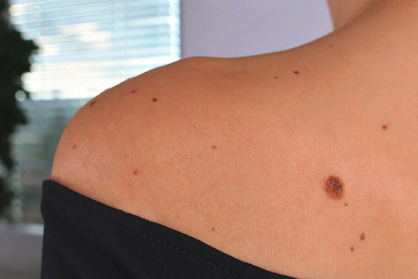 Меланома кожи меланома онкология. Фиброэпителиальный невус. Беспегментная меланомамеланома. Дерматофиброма и меланома. Диспластический невус.