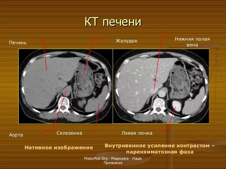 Компьютерная томография печени. Цирроз печени на кт с контрастом. Кт норма печень