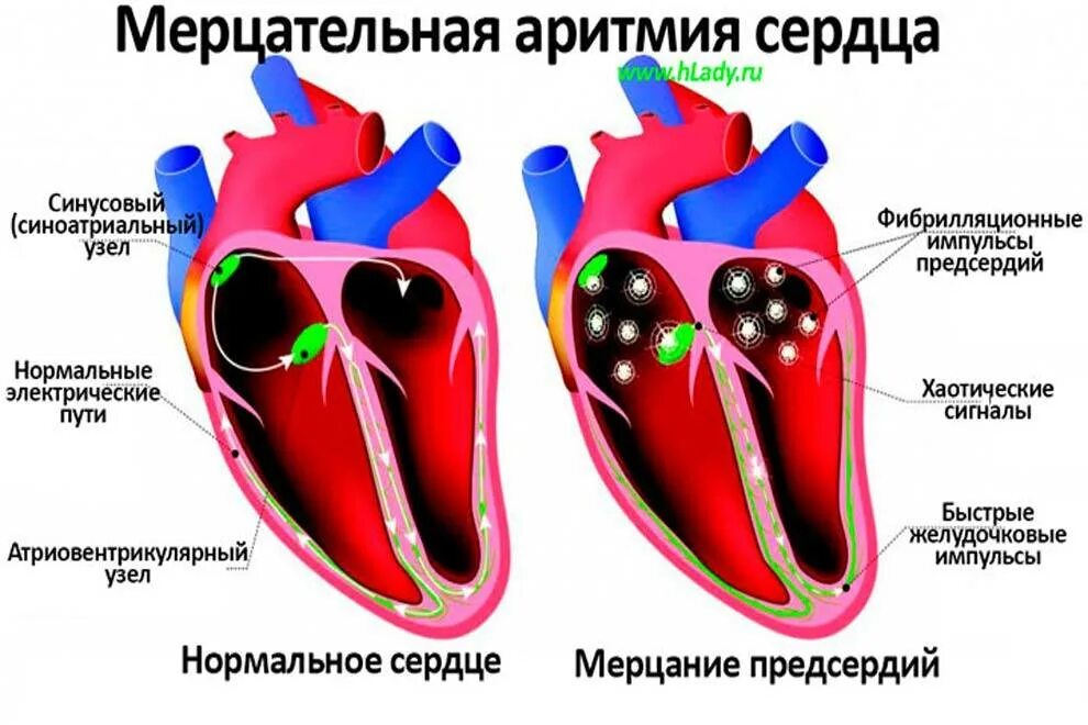 Аритмия нарушение ритма сердца. Мерцательная аритмия. мерцательная аритмия сердца. мерцающая аритмия. мерцание предсердий аритмия?.