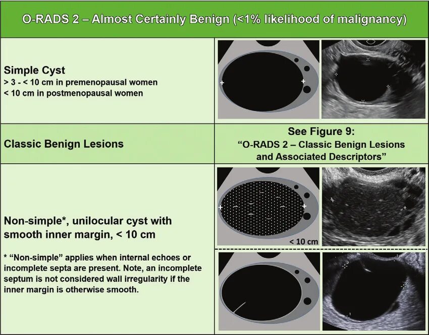 Киста яичника o rads. O-rads УЗИ. Классификация orads. Классификация o-rads для УЗИ.
