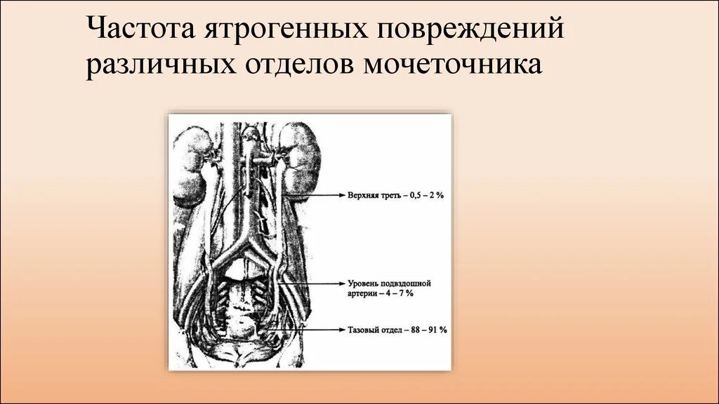 Травма мочеточника. Ятрогенные повреждения мочеточников. Топографическая анатомия мочеточников. Ятрогенная травма мочеточника.