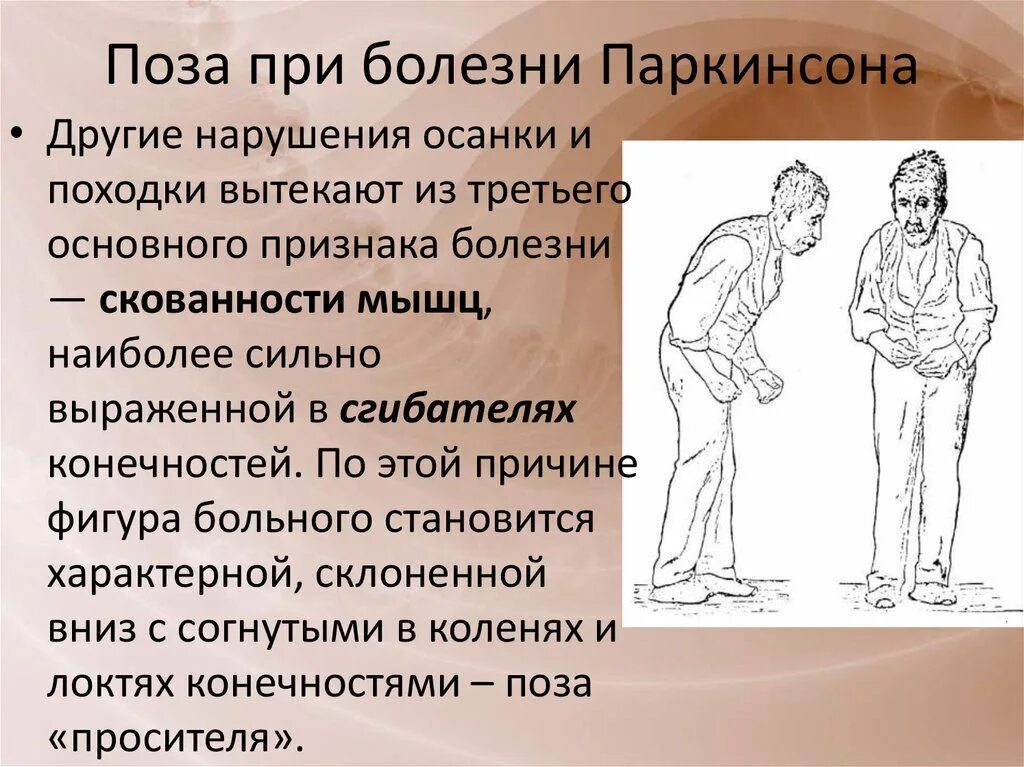 Прогрессирование болезни паркинсона. Тремор паркинсона. Синдромы при болезни паркинсона. Болезнь паркинсона этиология. Клинические проявления синдрома паркинсонизма.