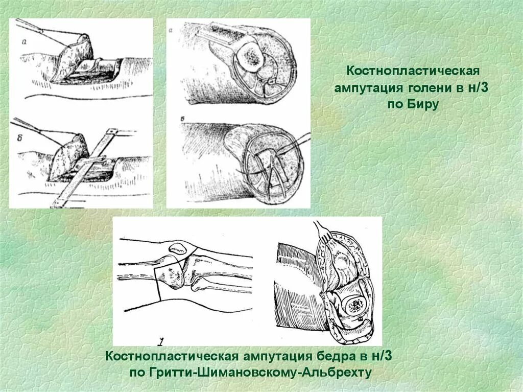 Костно-пластическая ампутация бедра по Гритти-Шимановскому. Костно пластическая ампутация голени по Гритти Шимановскому. Костно-пластическая ампутация бедра по Гритти-Шимановскому-Альбрехт. Ампутация костно пластическая ампутация по Гритти Шимановскому.