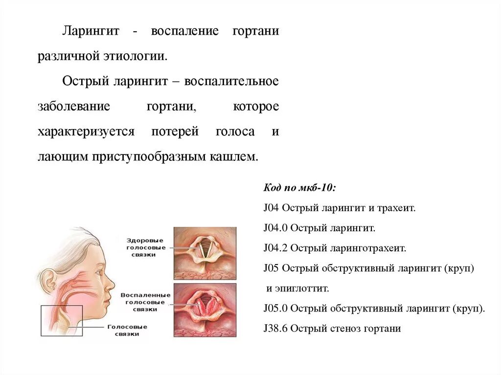 Ларингит сколько дней длится. Ларингит клинические проявления. острый ларингит код у детей. катаральный ларингит этиология. ринит фарингит ларингит.